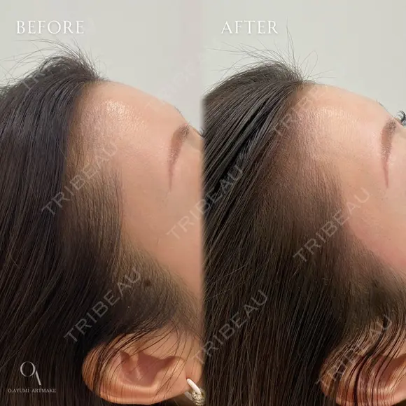ヘアラインアートメイク before画像 メイン用