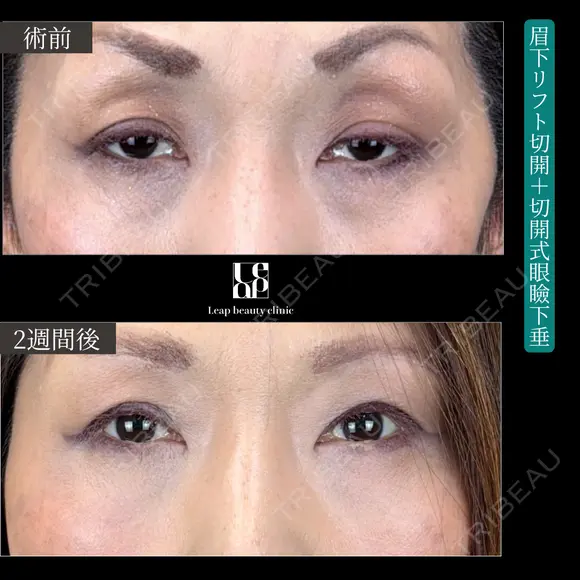 眉下リフト＋切開式眼瞼下垂 14日後 メイン用