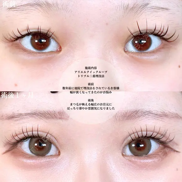 アリエルクイックループトリプル二重埋没法 before画像 メイン用