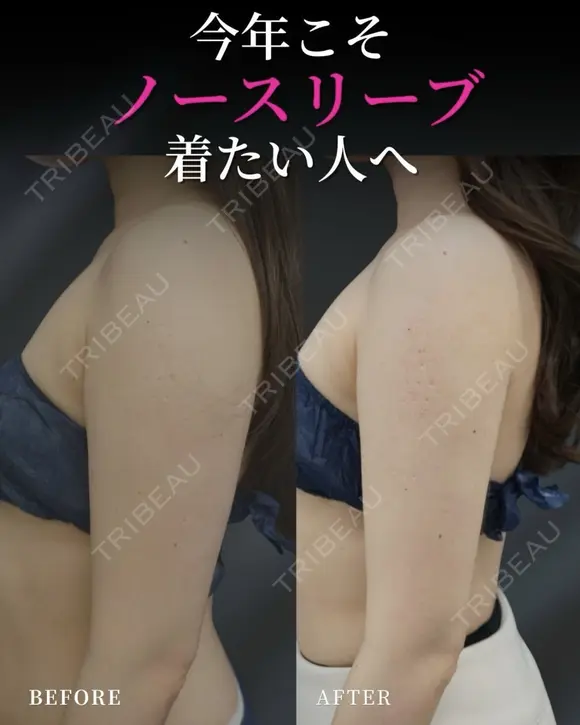 ノースリーブが似合う人に！👗💖 before画像 メイン用