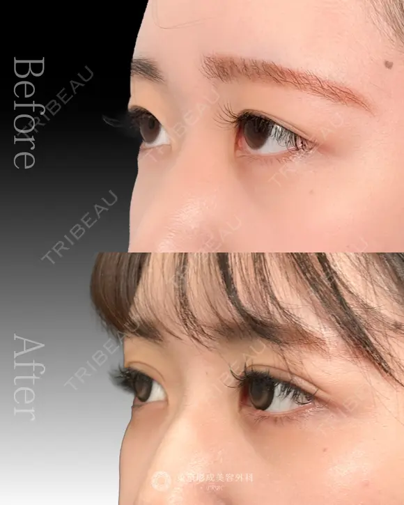 二重埋没法 before画像 メイン用