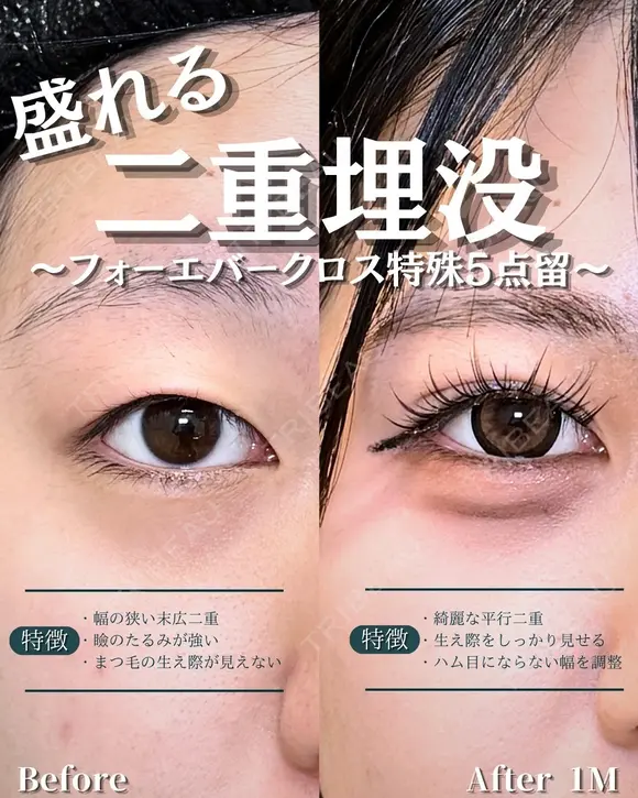 【二重埋没法】フォーエバークロス特殊5点留め before画像 メイン用