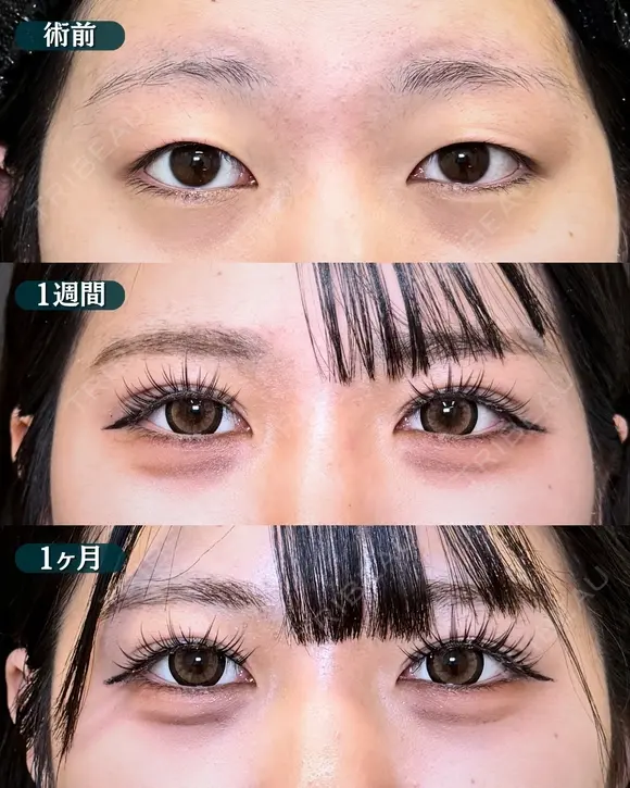 【二重埋没法】フォーエバークロス特殊5点留め after画像 メイン用