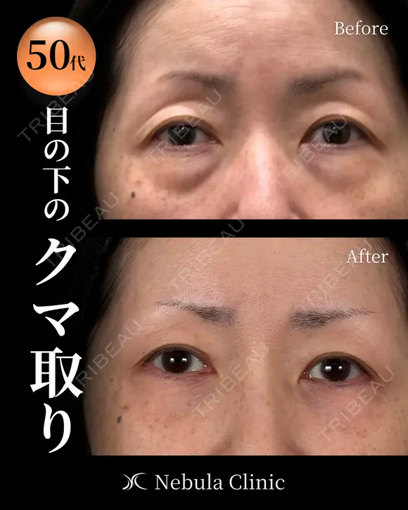 🐻DR都築🐻切らないクマ取り before画像 メイン用