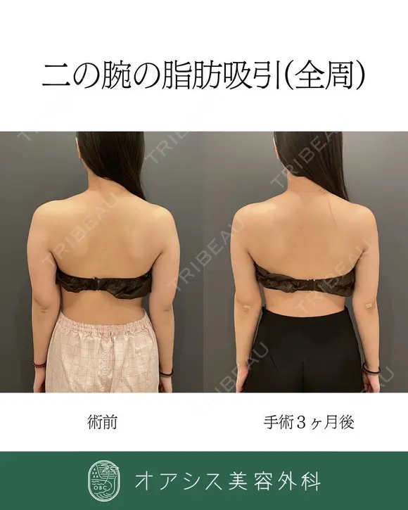 カリカリボディを目指す🌴コンプリート脂肪吸引【上腕全周～お背中一部】形成外科専門医がご対応 before画像 メイン用