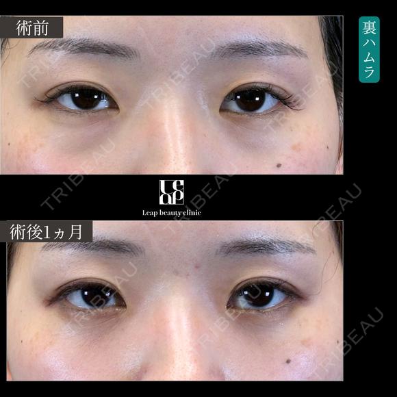 裏ハムラ 30日後 メイン用