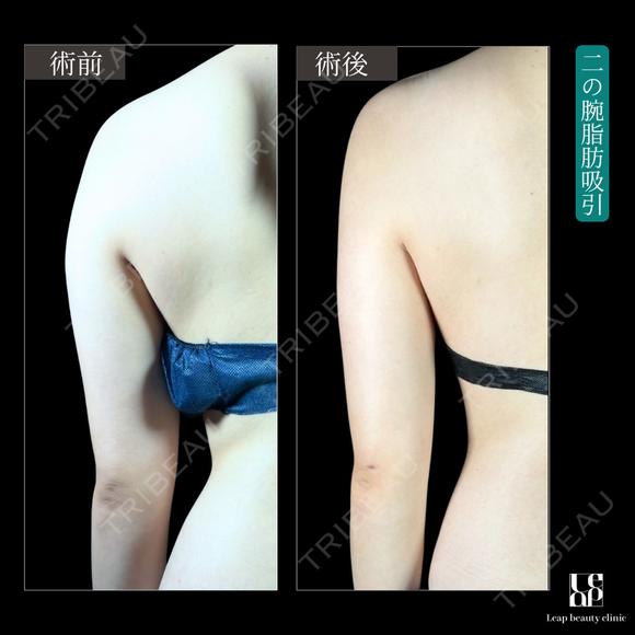 二の腕・肩脂肪吸引 before画像 メイン用