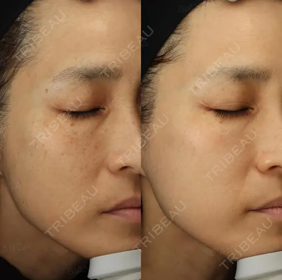 ルメッカ before画像 メイン用