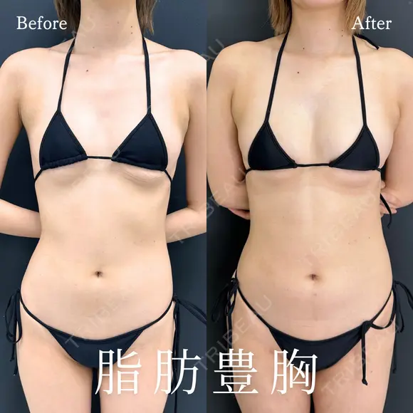 脂肪豊胸 before画像 メイン用