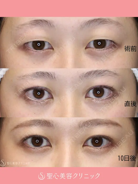 【20代女性】二重術（埋没法）：マイクロメソッド+α（10日後） 10日後 メイン用