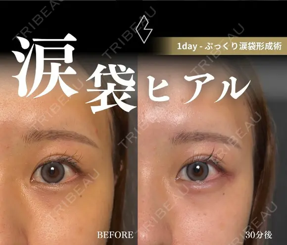涙袋ヒアルロン酸 before画像 メイン用