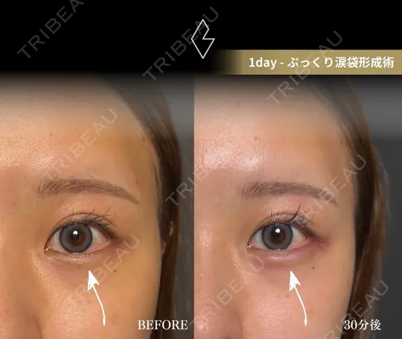 涙袋ヒアルロン酸 0日後 メイン用