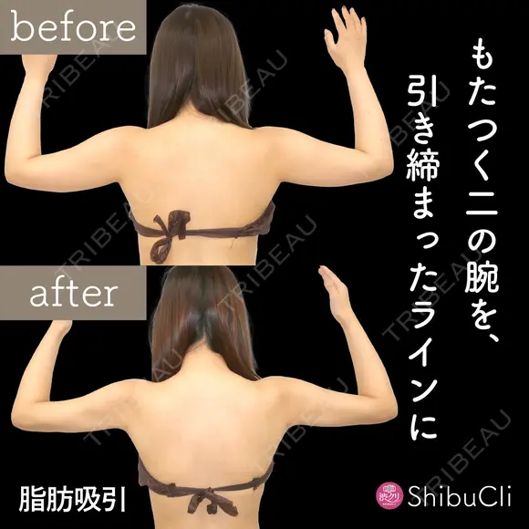 脂肪吸引 before画像 メイン用