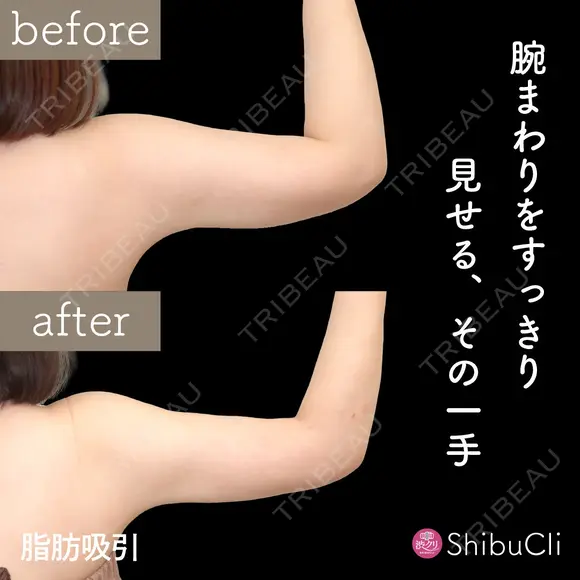 脂肪吸引 30日後 メイン用