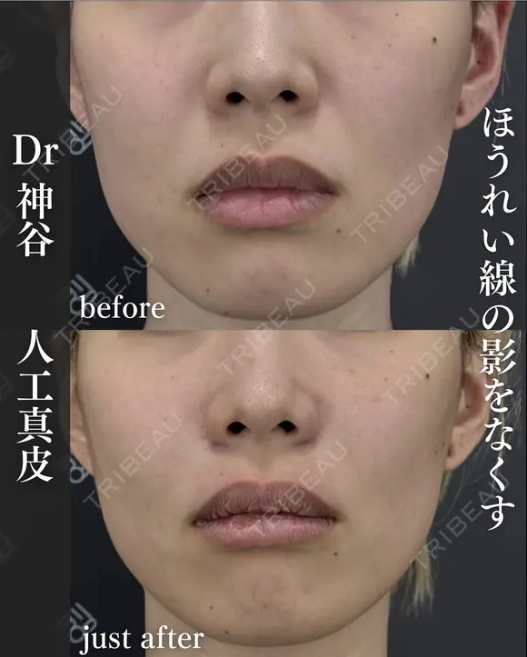 貴族手術（人工真皮） after画像 メイン用