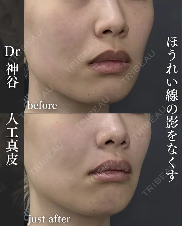 貴族手術（人工真皮） after画像 メイン用