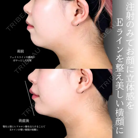 顎ヒアルロン酸 before画像 メイン用