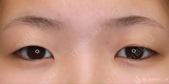 【10代女性・パッチリ二重に】二重全切開術＋脂肪除去（1ヶ月後） before画像 メイン用
