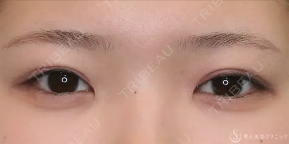 【10代女性・パッチリ二重に】二重全切開術＋脂肪除去（1ヶ月後） 30日後 メイン用