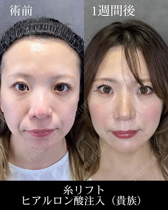 糸リフト/ヒアルロン酸注入（貴族） before画像 メイン用