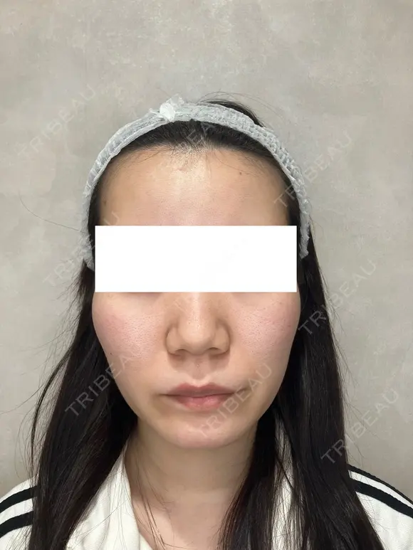毛穴・クレーターまとめて改善｜トライフィルプロ症例 before画像 メイン用