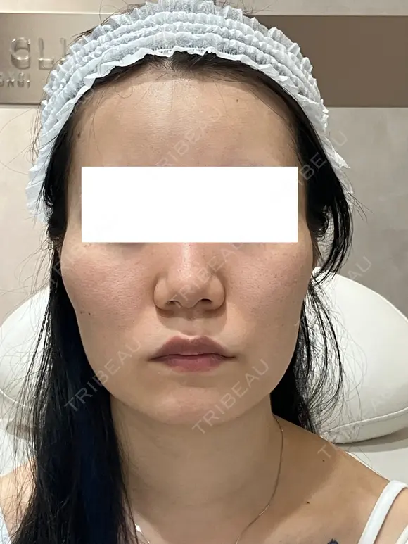 毛穴・クレーターまとめて改善｜トライフィルプロ症例 60日後 メイン用