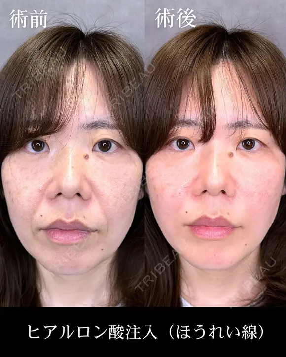 ヒアルロン酸注入（ほうれい線） after画像 メイン用