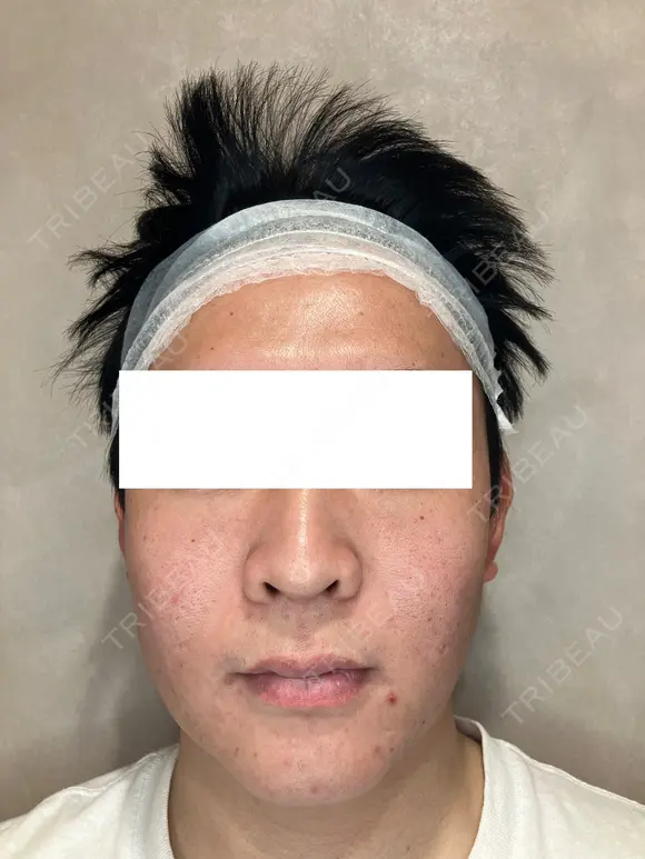 ニキビ跡・毛穴に集中アプローチ｜トライフィルプロでなめらか肌へ before画像 メイン用
