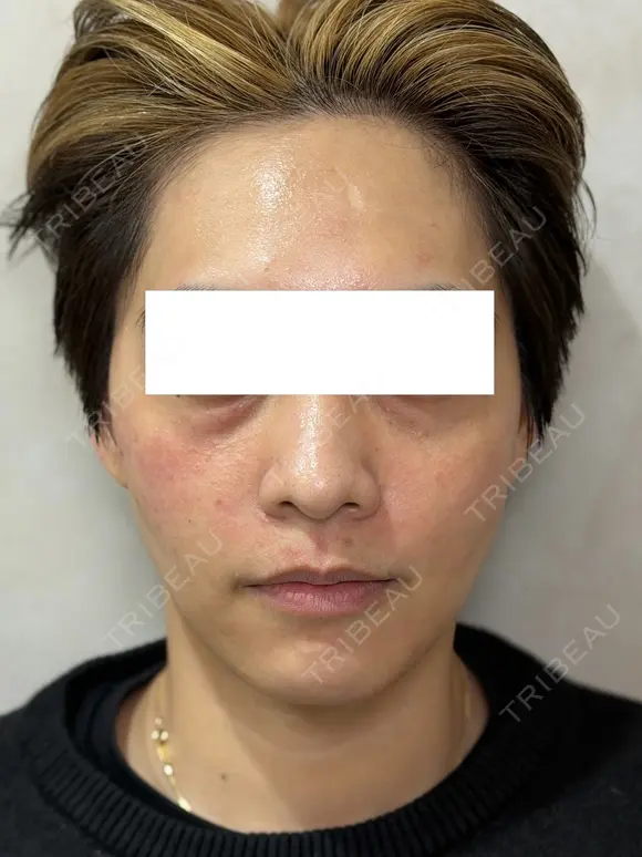 毛穴・皮脂ケアに｜ブラックピールでつるん肌へ 0日後 メイン用