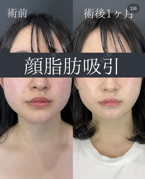 顔脂肪吸引(ホホ下+フェイスライン+アゴ下+エラ下+首側面+首前面) after画像 メイン用