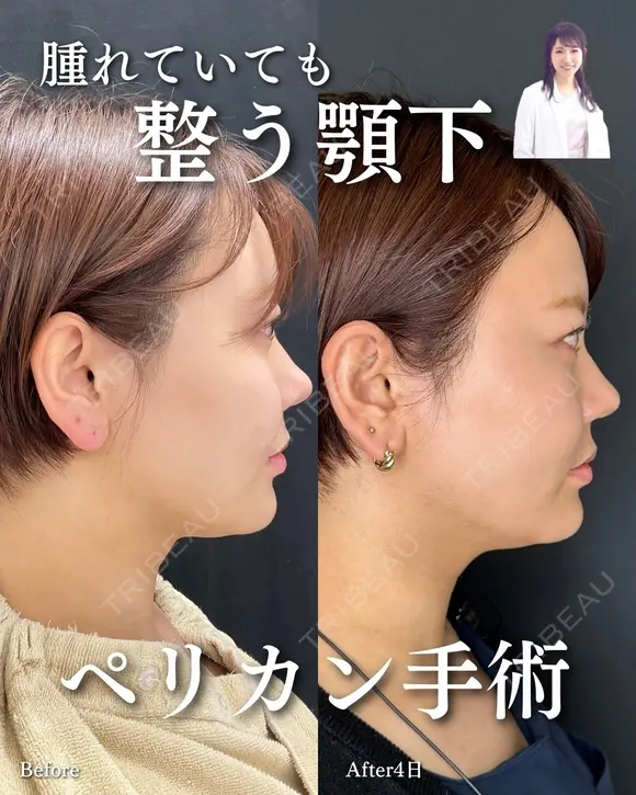 ペリカン手術 before画像 メイン用