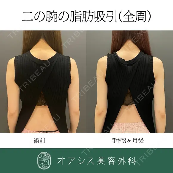 カリカリボディを目指す🌴コンプリート脂肪吸引【上腕全周～お背中一部】形成外科専門医がご対応 after画像 メイン用