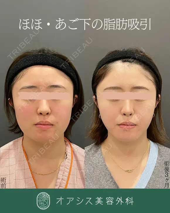 脂肪吸引のみですっきり🌴コンプリート脂肪吸引【頬・顎下】形成外科専門医がご対応 after画像 メイン用