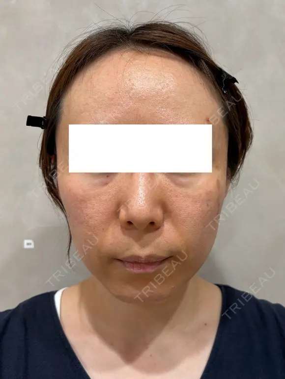 クレーター改善の切り札｜サブシジョンで凹み肌をなめらかに before画像 メイン用
