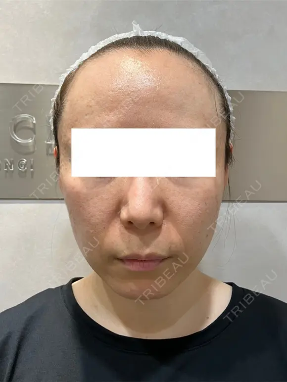 クレーター改善の切り札｜サブシジョンで凹み肌をなめらかに 30日後 メイン用