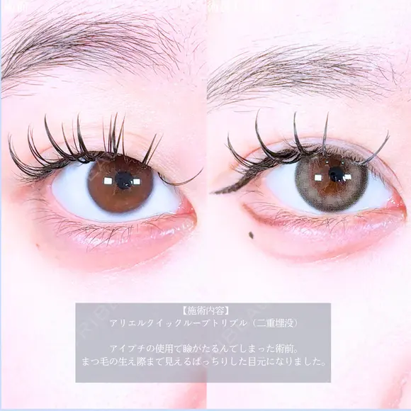 アリエルクイックループトリプル二重埋没法 before画像 メイン用