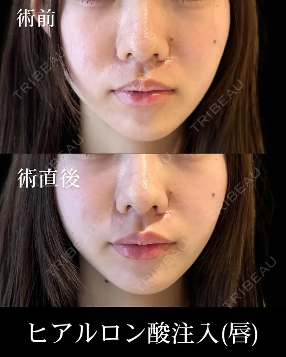 ヒアルロン酸注入 before画像 メイン用