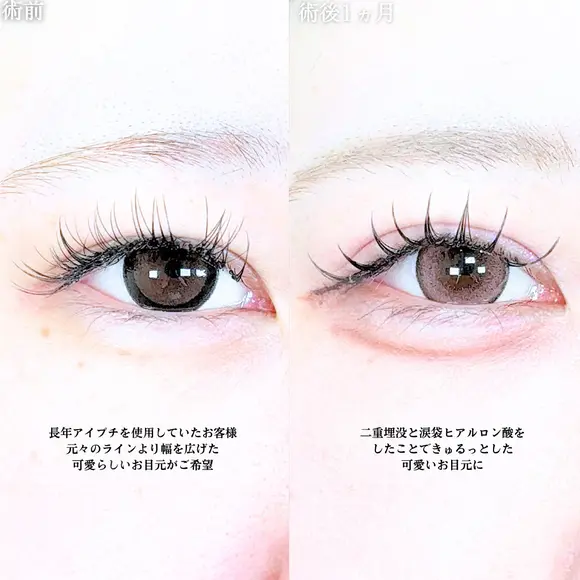 アリエルクイックループトリプル二重埋没法/涙袋ヒアルロン酸 before画像 メイン用
