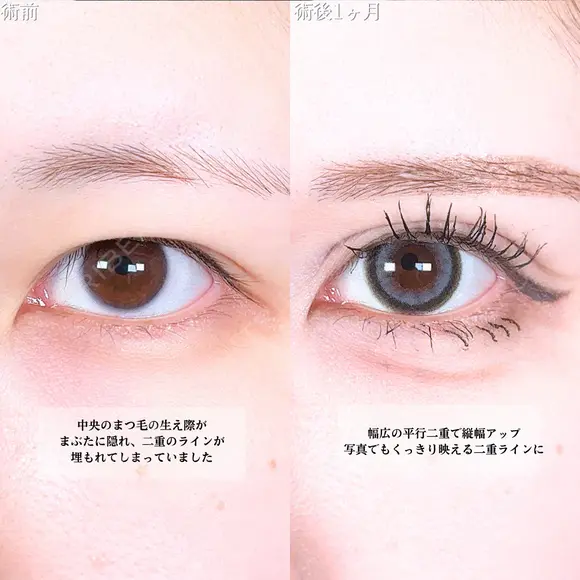 アリエルクイックループトリプル二重埋没法 before画像 メイン用