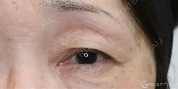 【60代女性・目の開きを改善】眼瞼下垂（切開法）＋眉下切開術（3ヶ月後） before画像 メイン用