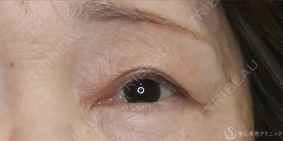 【60代女性・目の開きを改善】眼瞼下垂（切開法）＋眉下切開術（3ヶ月後） 90日後 メイン用