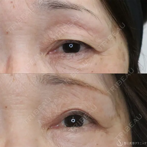 【60代女性・目の開きを改善】眼瞼下垂（切開法）＋眉下切開術（3ヶ月後） 90日後 メイン用