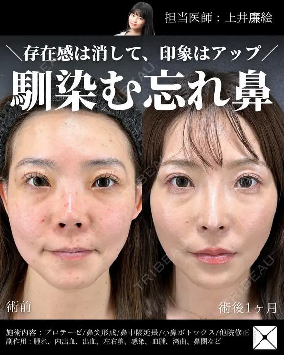 鼻整形（プロテーゼ/鼻尖形成/鼻中隔延長/小鼻ボトックス/他院修正） after画像 メイン用