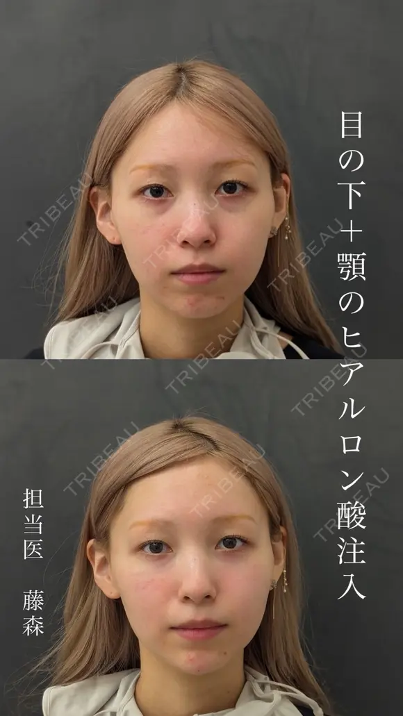 【目の下】ヒアルロン酸注入 before画像 メイン用