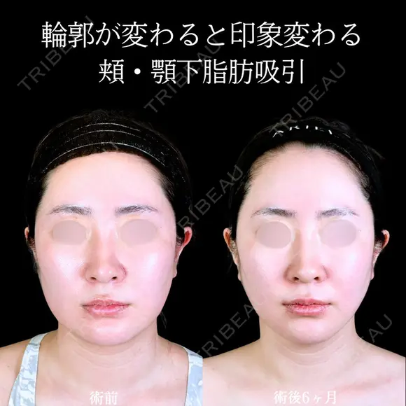 頬・顎下脂肪吸引/糸リフト/エラボトックス 180日後 メイン用