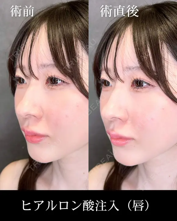 ヒアルロン酸注入（唇） before画像 メイン用