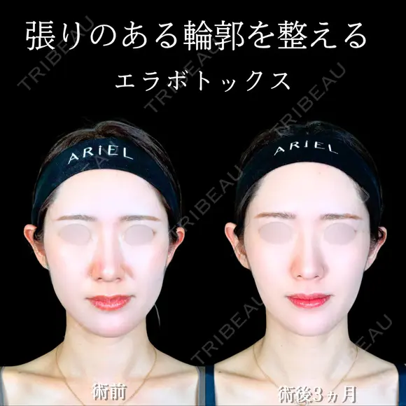 エラボトックス 90日後 メイン用