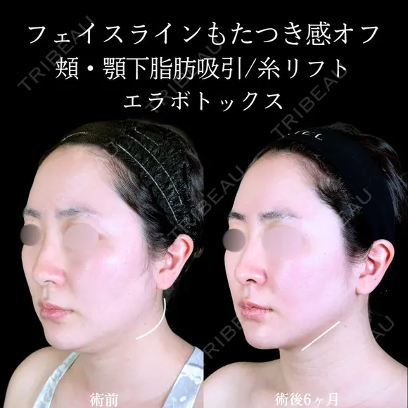 頬・顎下脂肪吸引/糸リフト/エラボトックス before画像 メイン用