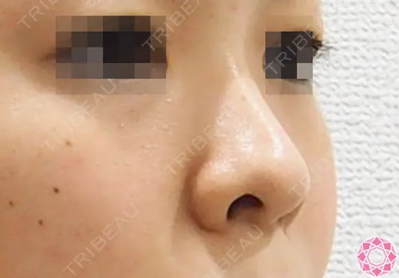 隆鼻術（シリコンプロテーゼ） +鼻翼（切開）ハイパー法 before画像 メイン用