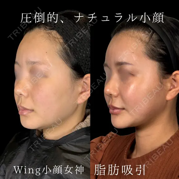 Wing小顔女神脂肪吸引 before画像 メイン用